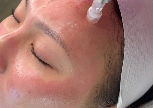 Microneedling with PRP & Serums
