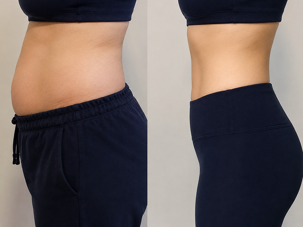 Abdominal Fat Reduction