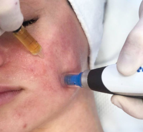 Microneedling with PRP