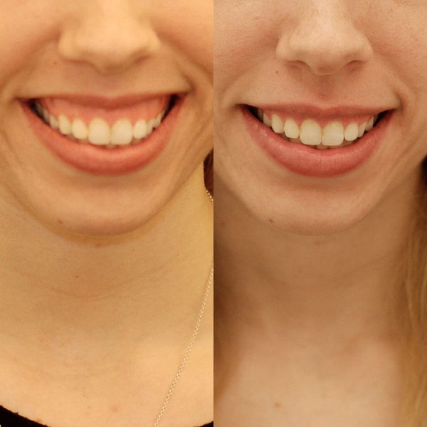 Botox — Gummy Smile