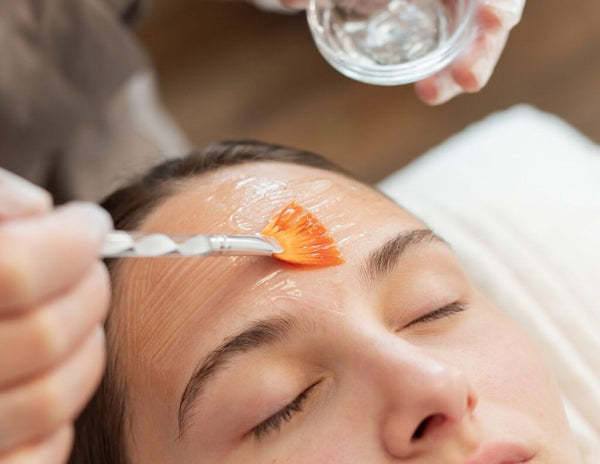 Acne Peel
