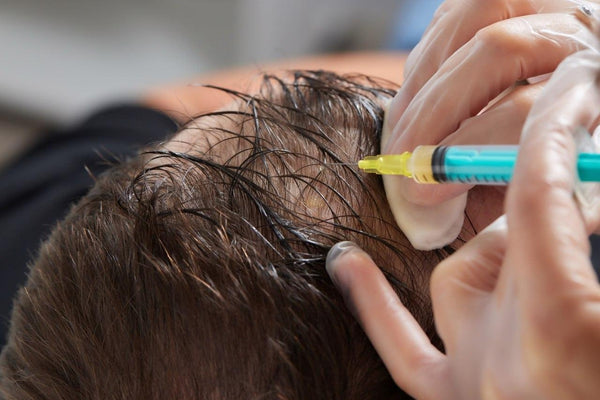 PRP for Scalp