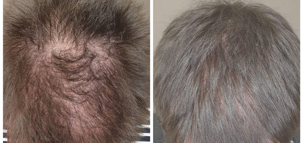 Mesotherapy for Hairfall