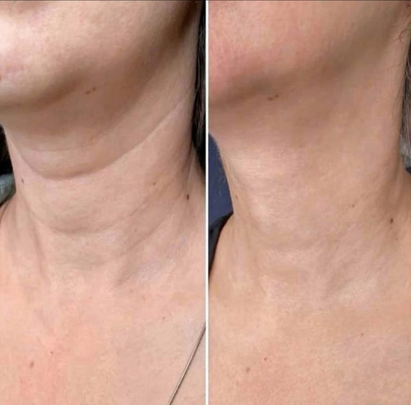 Polynucleotide for Neck Rejuvenation