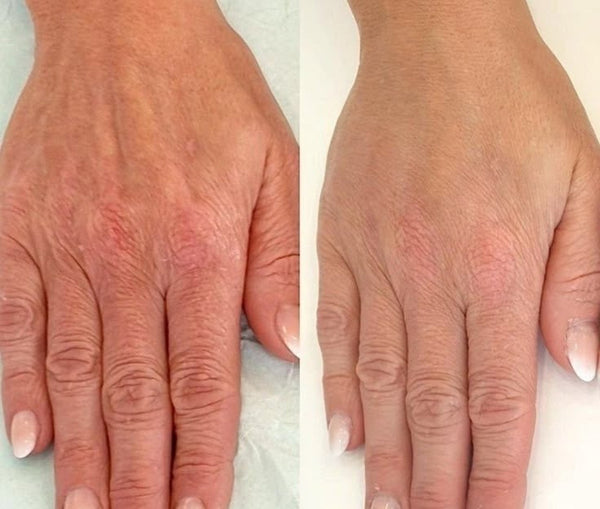 Microneedling — Hand / Feet