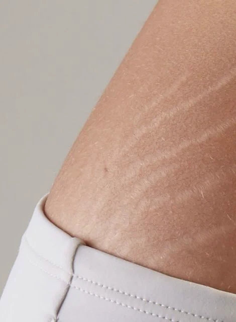 Microneedling for Stretch Marks
