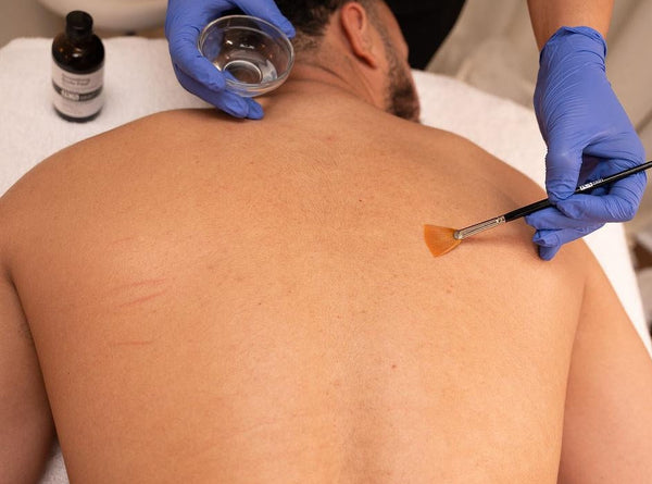 Skin Lightening Peel — Body