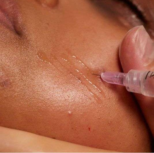 PRP Mesotherapy — Face