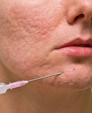 Subcision with PRP & Microneedling (Acne Scars)