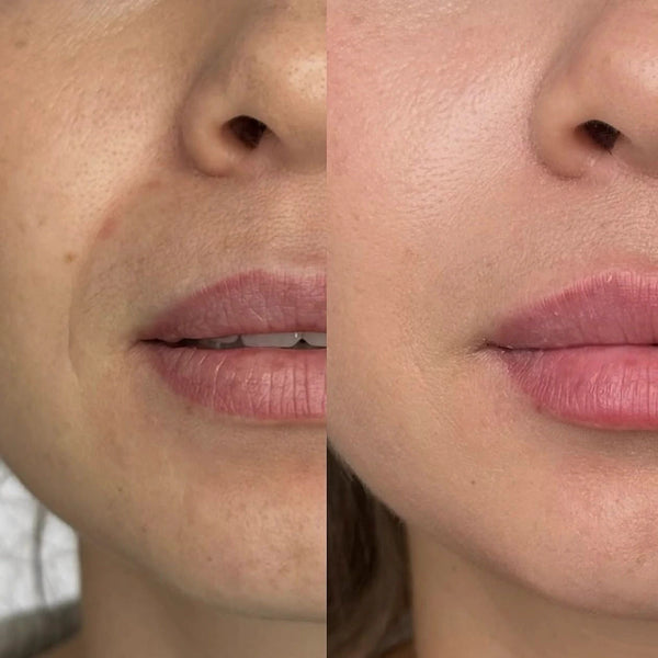 Filler for Sad Corners of Mouth