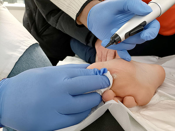 Wart Removal