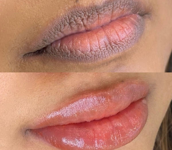 Carbon Peel for Dark Lips
