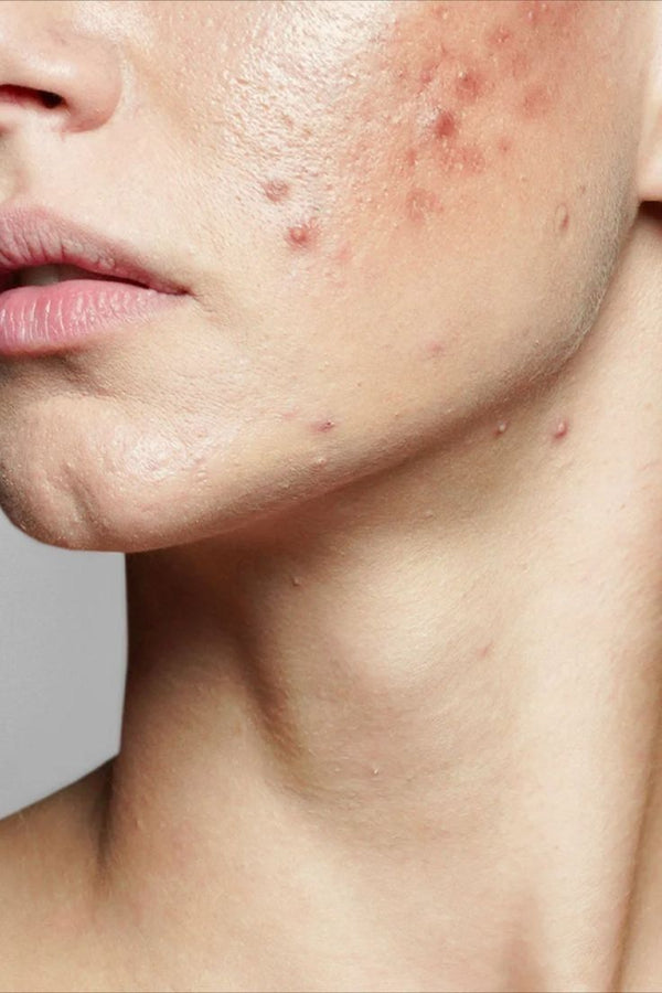 OxyGeneo Facial — Acne