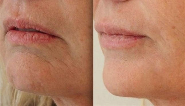 Botox — Sad Smile