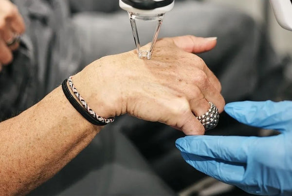 Carbon Laser Peel — Hands