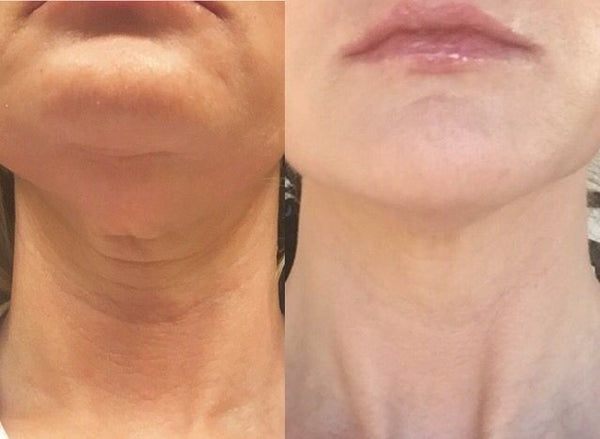 Nefertiti Lift (Non-Surgical Neck Lift)
