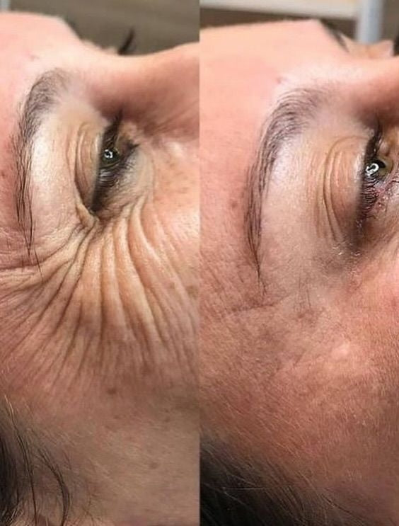 Botox — Eye Rejuvenation (Crow's Feet)