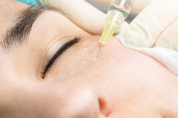 Under-Eye Mesotherapy