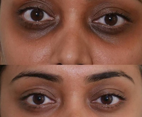 Carbon Peel for Under Eye