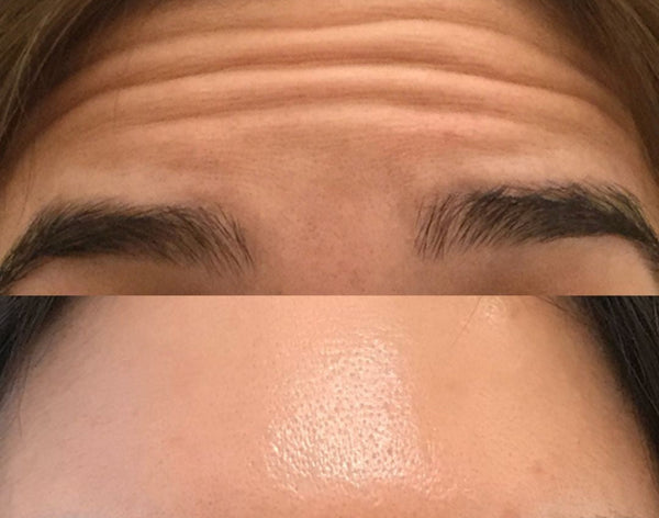 Botox — Forehead Smoothing