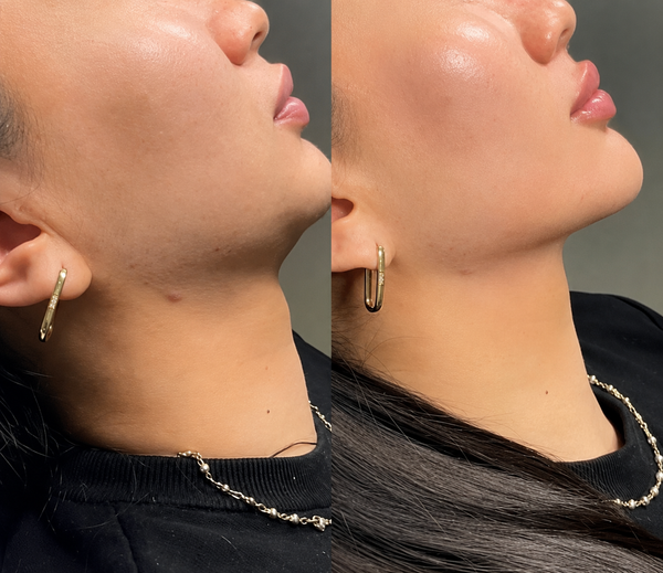 Double Chin Reduction