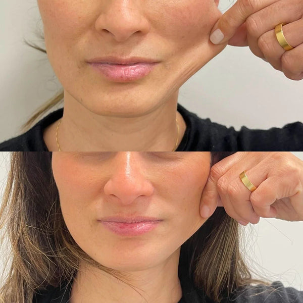 Sculptra