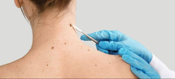 Skin Tag Removal
