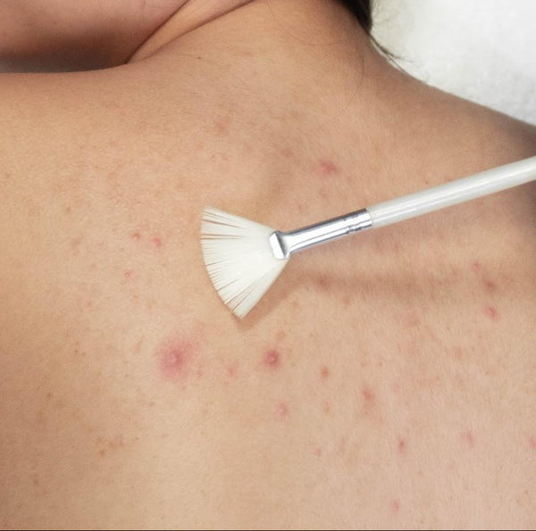 Peel for Back Acne