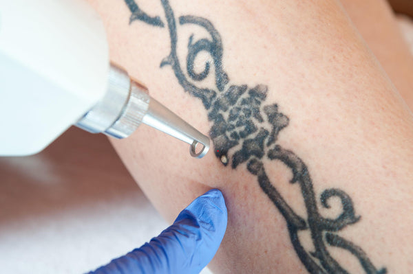 Laser for Tattoo Removal