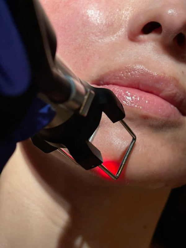 Carbon Laser Peel — Chin