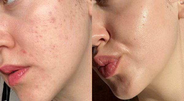 Korean  Salmon DNA Facial