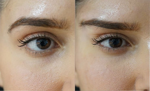 Fox Eye Botox (Eyebrow Lift)