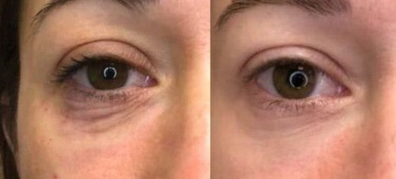 PRP — Under Eye