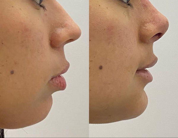 Botox — Nose Lift & Slimming