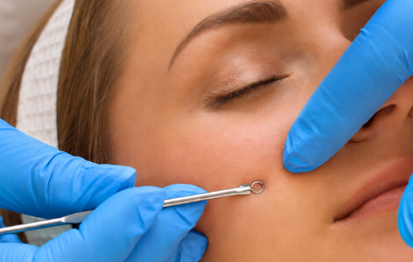 Comedonal Extraction