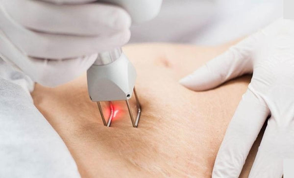 CO2 Laser for Stretch Marks