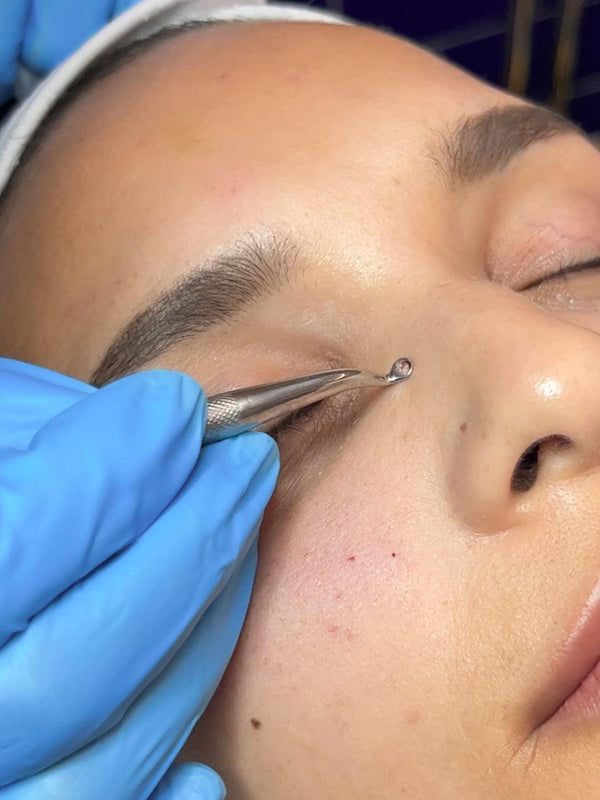 Milia Extraction