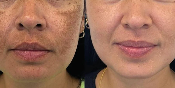 Melasma Peel
