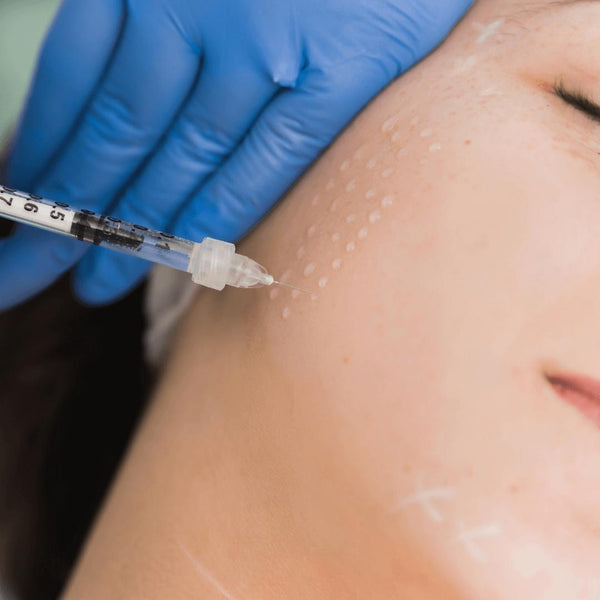 Mesobotox (Acne Scars/Fine Lines/Wrinkles)