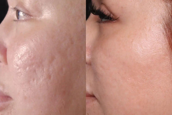 Scar Filler
