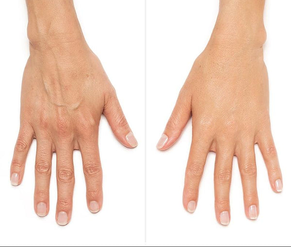 Filler for Hand Rejuvenation